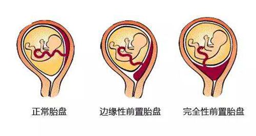 胎盘前置怎么长上去