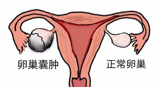 多囊卵巢综合征