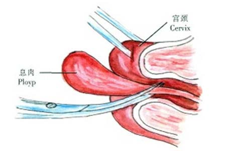 宫颈息肉谁做了谁后悔图片