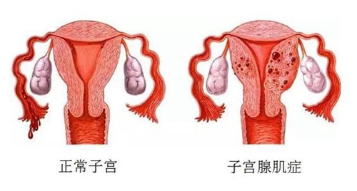 子宫腺肌症对胎儿有影响吗