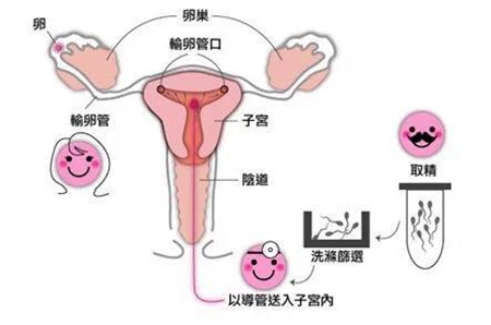 人工受孕痛吗