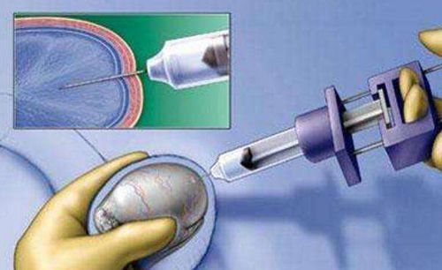 睾丸穿刺取精做试管成功率高吗