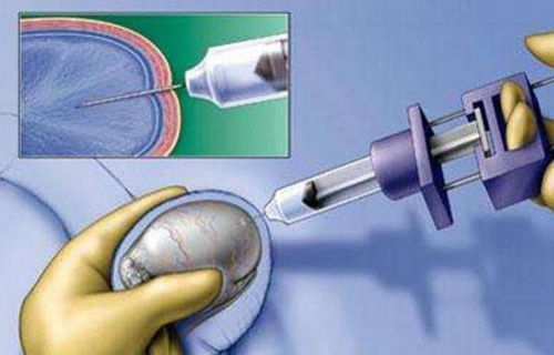 穿刺取精多少钱
