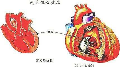 先天性心脏病